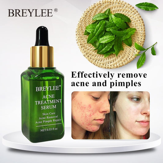 BREYLEE Acne Treatment Serum Face Facial Anti Acne Scar Removal Cream Skin Care Whitening Repair Pimple Remover For Acne Alicewonder